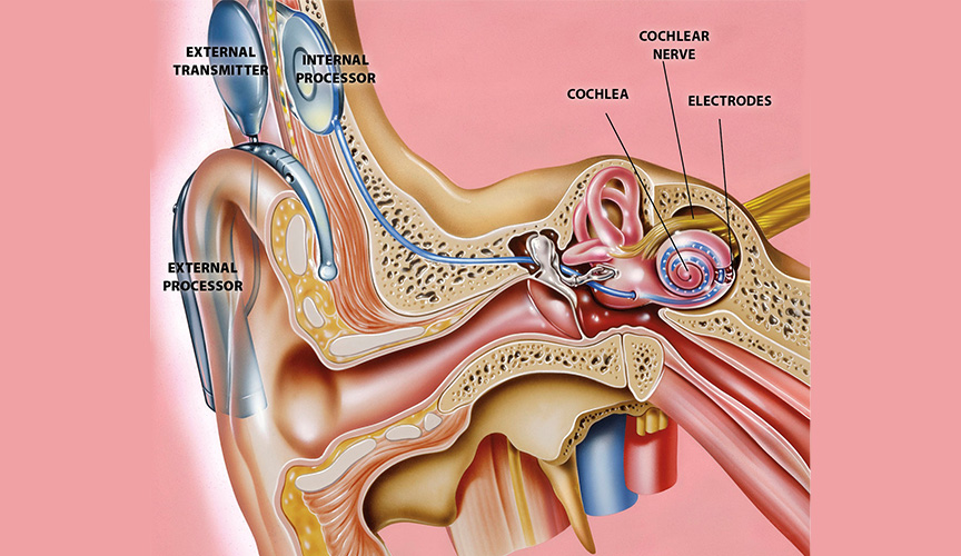 eleanor cochlear implant figure 2022